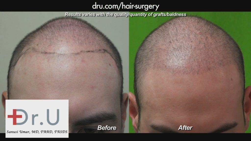 This young patient came to Dr. U for conservative coverage to regain his youthful look.* This young patient came to Dr. U for conservative coverage to regain his youthful look.*