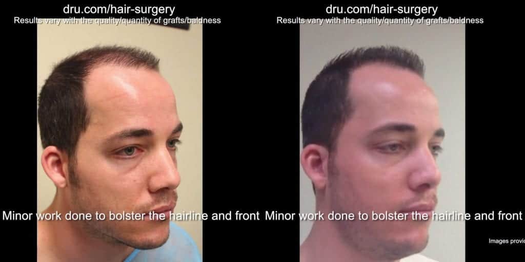 Low budget hair restoration before and after Low budget hair restoration before and after