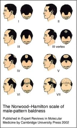 The Norwood-Hamilton Scale of Male-Pattern Baldness