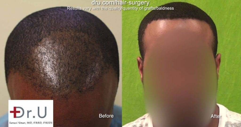 Video Best Tool For Fue Hair Transplant For Black Men