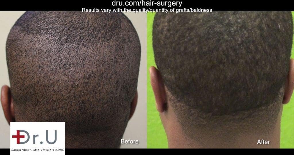 Video Best Tool For Fue Hair Transplant For Black Men