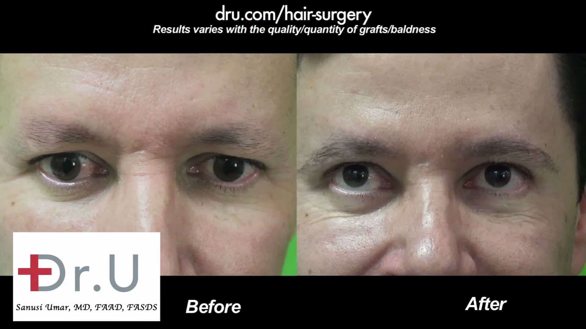 Eyebrow transplantation for men can greatly improve the way the eyes are framed as shown in these before and after photos Eyebrow transplantation for men can greatly improve the way the eyes are framed as shown in these before and after photos