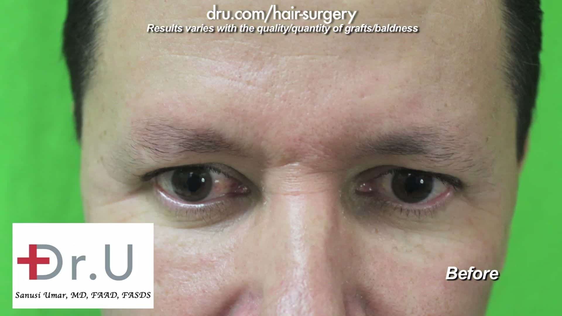 This patient feels his sparse eyebrows are unflattering in appearance and do not frame his face properly. He is, therefore, choosing to undergo an FUE eyebrow transplant for men. This patient feels his sparse eyebrows are unflattering in appearance and do not frame his face properly. He is, therefore, choosing to undergo an FUE eyebrow transplant for men.