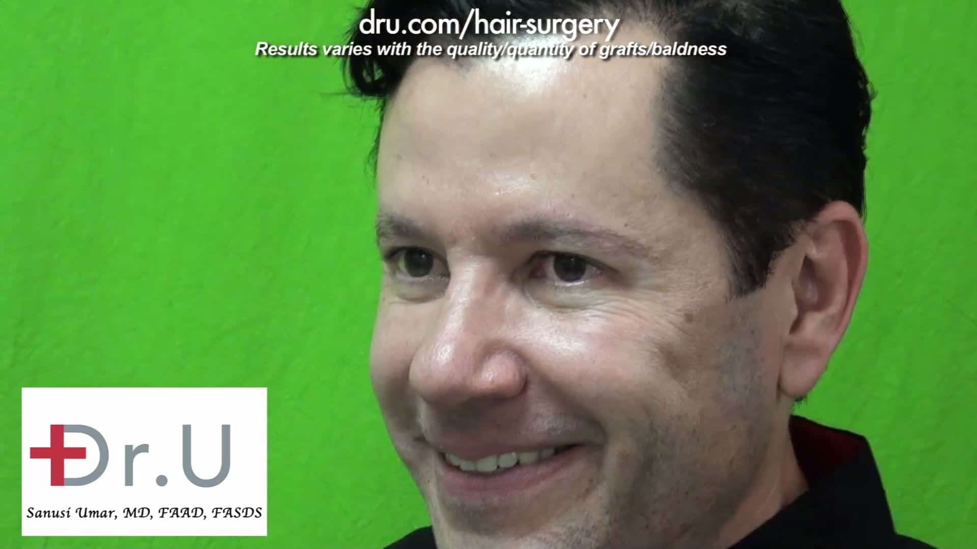 Thicker brows for men can be achieved with an FUE eyebrow transplant. A soft, subtle look is made possible by using thinner hairs from areas like the legs Thicker brows for men can be achieved with an FUE eyebrow transplant. A soft, subtle look is made possible by using thinner hairs from areas like the legs
