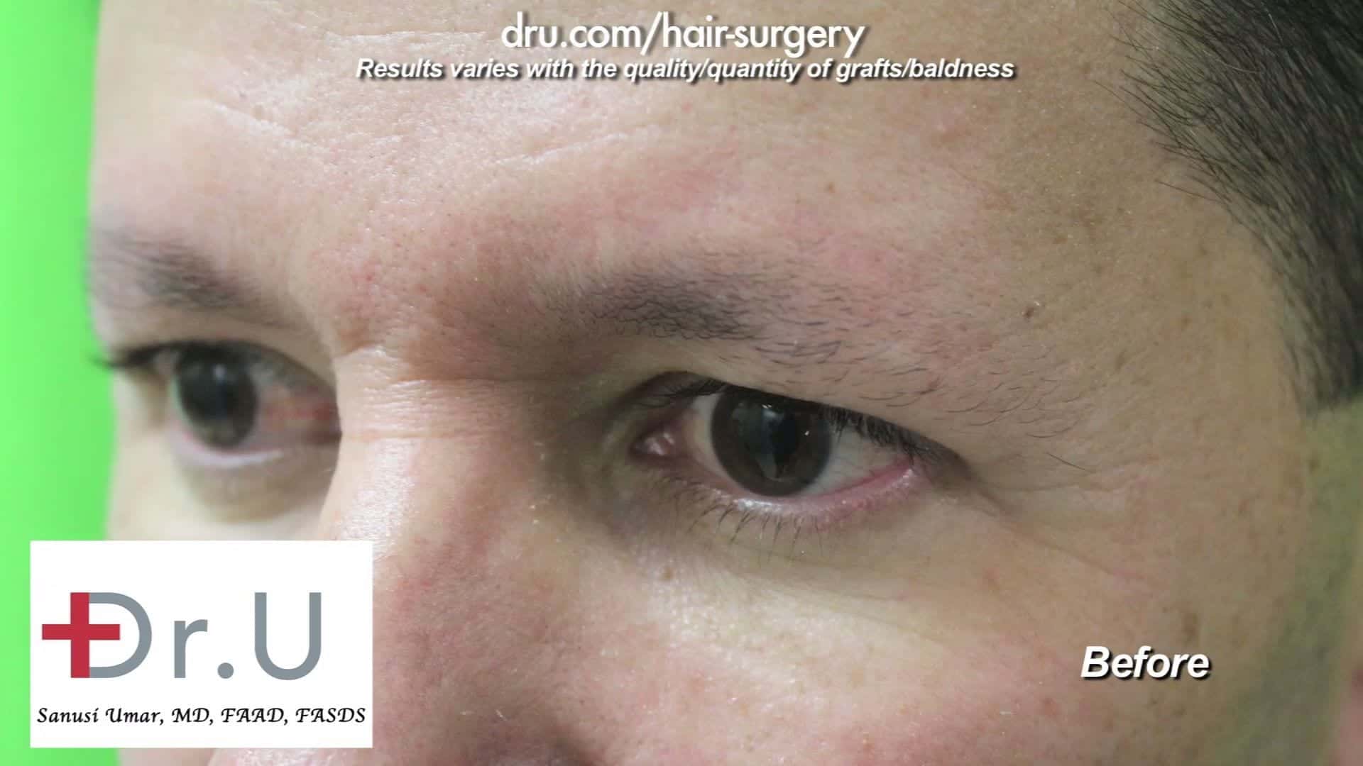 Before Male eyebrow transplant by Dr U, this patient is missing the outer half of his brows 300 leg hair grafts will be transplanted for this male eyebrow restoration surgery to restore a fuller eyebrow look.