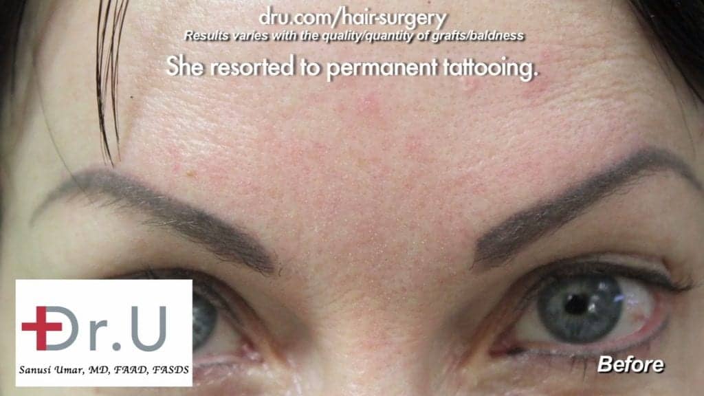 Eyebrow Tattooing did little to give the patient a natural look. It looked fake and fades over time Eyebrow Tattooing did little to give the patient a natural look. It looked fake and fades over time