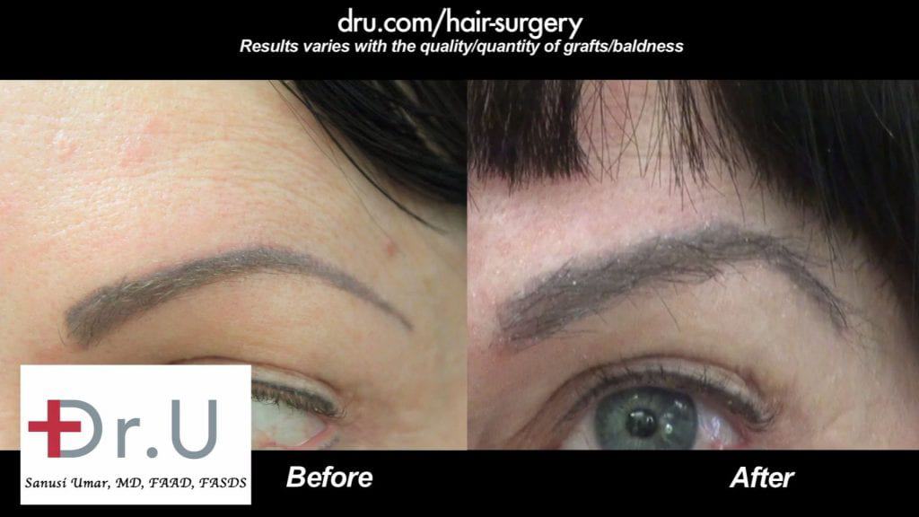 Which to have, Dr UGraft eyebrow hair restoration or Eyebrow tattoo ? The results shown in this picture should favor Transplantation Which to have, Dr UGraft eyebrow hair restoration or Eyebrow tattoo ? The results shown in this picture should favor Transplantation