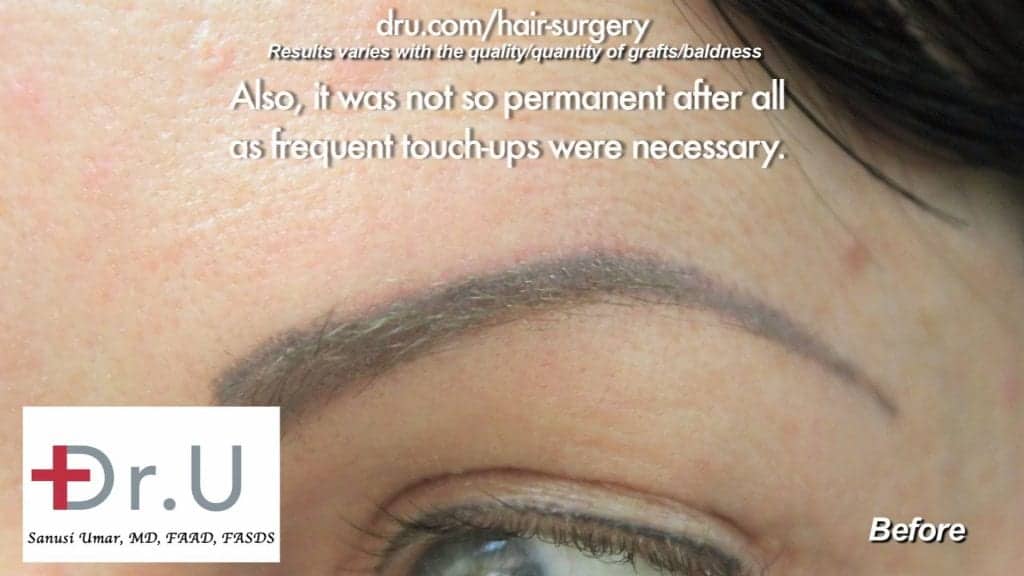 This pateint had an eyebrow tattoo, but it did not look like eyebrow hair especially on closer examination This pateint had an eyebrow tattoo, but it did not look like eyebrow hair especially on closer examination
