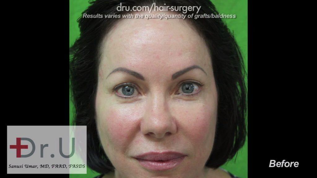 Eyebrow Tattoos Before Eyebrow Hair Transplant Photos: Eyebrow Tattoos Before Eyebrow Hair Transplant Photos: