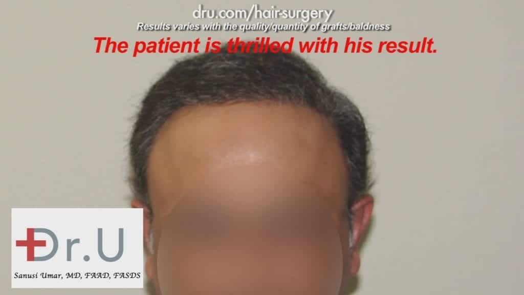 The Severe Hair Loss Restoration Cost was definitely worth it for this NW 7 patient The Severe Hair Loss Restoration Cost was definitely worth it for this NW 7 patient