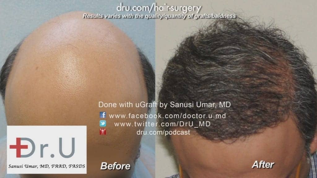 NW 7 Hair Restoration: Before and after photos contrasting the effects of BHT NW 7 Hair Restoration: Before and after photos contrasting the effects of BHT
