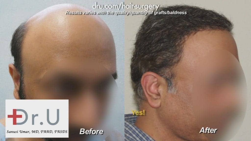Severe hair loss treatment using the Dr.UGraft BHT system Severe hair loss treatment using the Dr.UGraft BHT system
