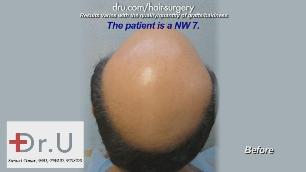 Severe Baldness Corrected Using 12000 DrUGrafts from Head and Beard Severe Baldness Corrected Using 12000 DrUGrafts from Head and Beard