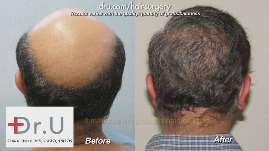 Dramatic results from treatment with the Dr.UGraft Dramatic results from treatment with the Dr.UGraft