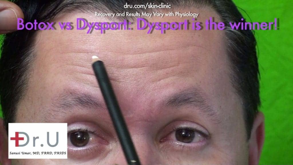 Positive Patient Results Hours After Dysport Injections Positive Patient Results Hours After Dysport Injections
