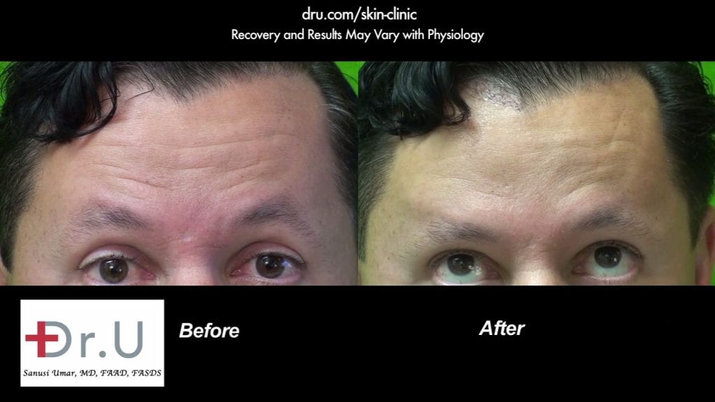 Before and after pictures of Dysport injections for frown lines. The patient was happy with his choice of Dysport vs Botox . * Before and after pictures of Dysport injections for frown lines. The patient was happy with his choice of Dysport vs Botox . *