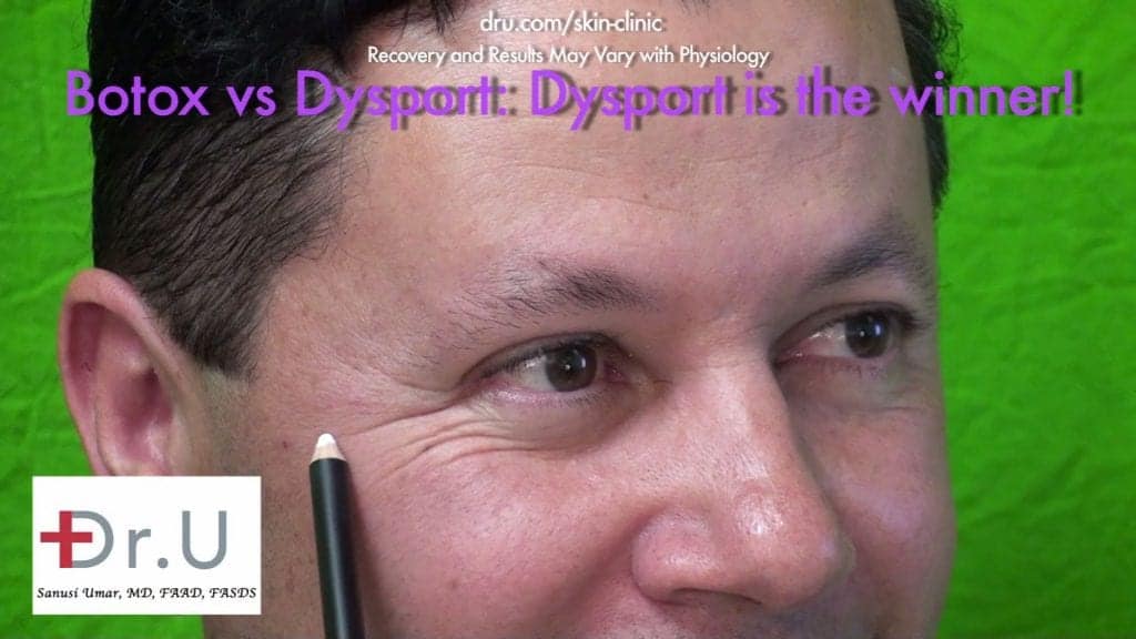 Crows feet - Positive Patient Results Hours After Dysport Injections Crows feet - Positive Patient Results Hours After Dysport Injections