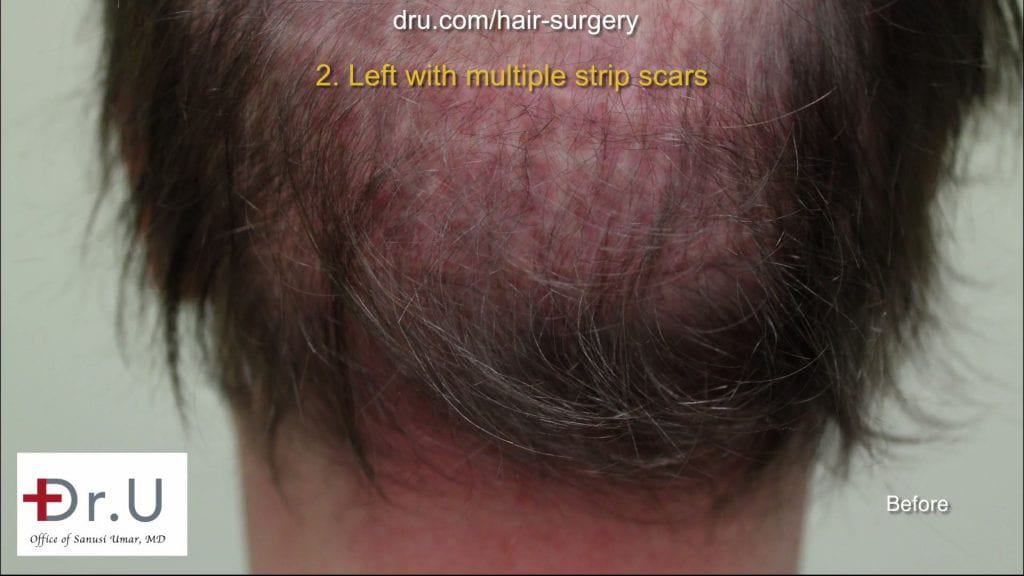 Before Strip Surgery Hair Transplant Repair Botched and Donor Depleted Severely Bald Patient Repaired: The patient had visible strip scars from surgeries performed by other doctors.