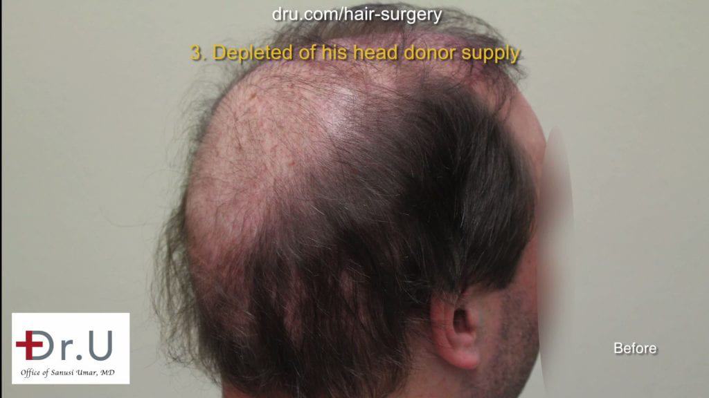 Botched and Donor Depleted Severely Bald Patient Repaired: Before hair transplant repair with Dr. Umar Botched and Donor Depleted Severely Bald Patient Repaired: Before hair transplant repair with Dr. Umar