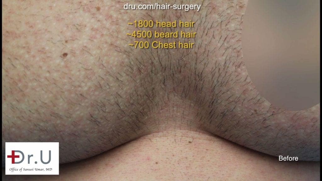 Dr.UGrafts were harvested from the beard, head and chest. Hair restored with the Dr.UGraft using body hair
