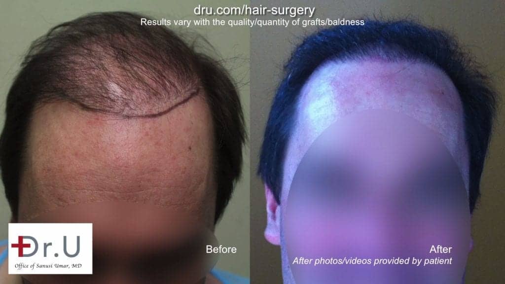 DrUGraft BHT FUE Hair Repair Donor Depleted Norwood 6 Patient DrUGraft BHT FUE Hair Repair Donor Depleted Norwood 6 Patient