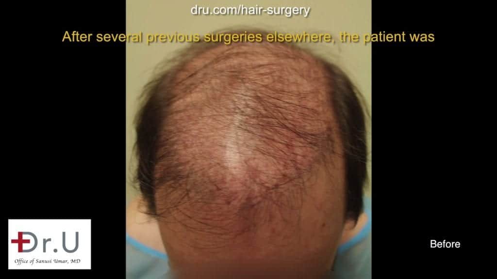 Botched and Donor Depleted Severely Bald Patient Repaired: Before undergoing the Dr.UGraft, this patient had visible scarring and high level baldness. Botched and Donor Depleted Severely Bald Patient Repaired: Before undergoing the Dr.UGraft, this patient had visible scarring and high level baldness.