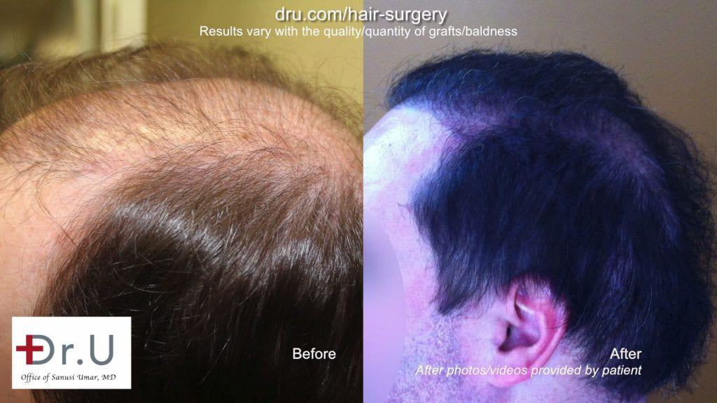 Botched and donor depleted severely bald patient repaired by Dr.UGraft hair surgery Botched and donor depleted severely bald patient repaired by Dr.UGraft hair surgery