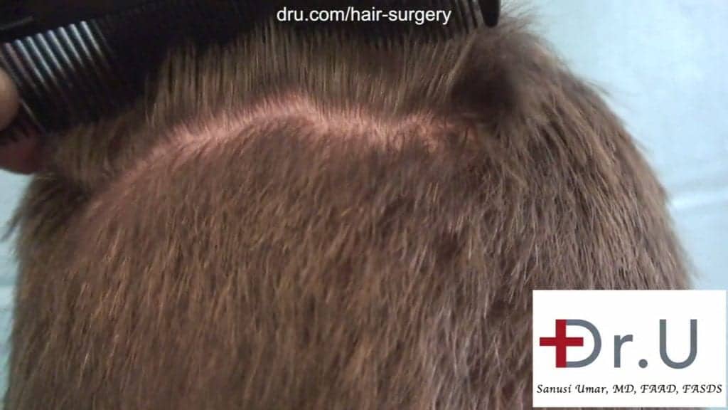 What is the cost of restoring a receding hairline by FUE hair transplant:The Dr.UGraft gave the patient natural looking results. What is the cost of restoring a receding hairline by FUE hair transplant:The Dr.UGraft gave the patient natural looking results.