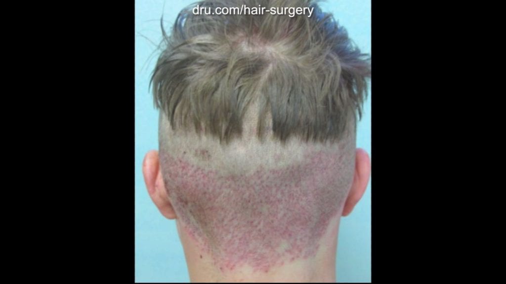 This image shows his nape immediately after surgery. The wounds from the Dr.UGraft procedure usually heal in a month or less. This image shows his nape immediately after surgery. The wounds from the Dr.UGraft procedure usually heal in a month or less.