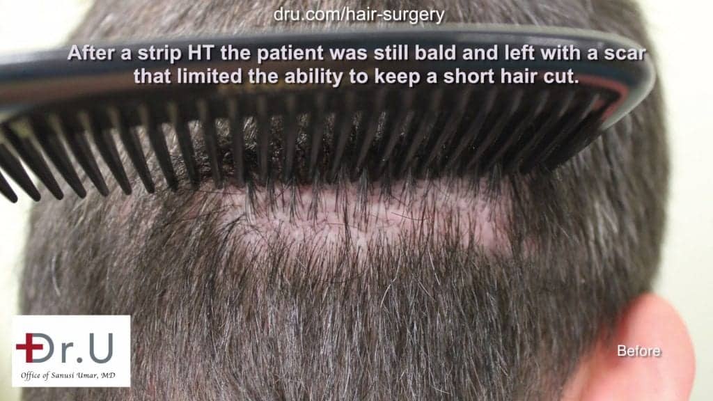 Scar on the back of patient's head, prior to low budget hair restoration and scar repair Scar on the back of patient's head, prior to low budget hair restoration and scar repair