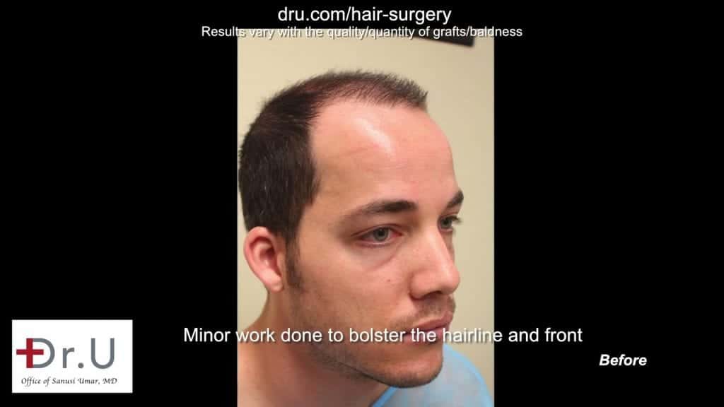 Hair loss prior to Dr UGraft FUE Hair Transplant Using 1600 Head Grafts For Strip Scar Restoration Hair loss prior to Dr UGraft FUE Hair Transplant Using 1600 Head Grafts For Strip Scar Restoration