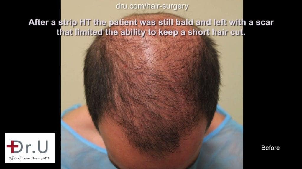 Dr UGraft FUE Hair Transplant Using 1600 Head Grafts For Subtle Strip Scar Restoration - Top View, Before Procedure Dr UGraft FUE Hair Transplant Using 1600 Head Grafts For Subtle Strip Scar Restoration - Top View, Before Procedure