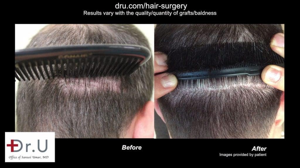 A low density hair restoration managed to cover the patient's previous scar with a natural look thanks to the Dr.UGraft and a low graft count hair transplant A low density hair restoration managed to cover the patient's previous scar with a natural look thanks to the Dr.UGraft and a low graft count hair transplant