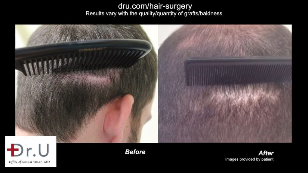 Scar from a previous strip surgery concealed by the DrUGraft subtle hair transplant Scar from a previous strip surgery concealed by the DrUGraft subtle hair transplant