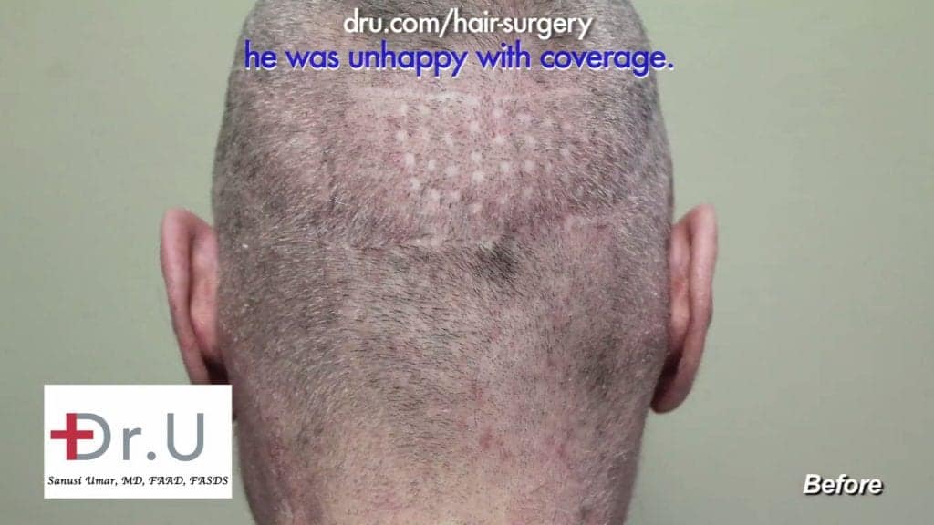 Round "Black and Decker" punch scars. Round "Black and Decker" punch scars.