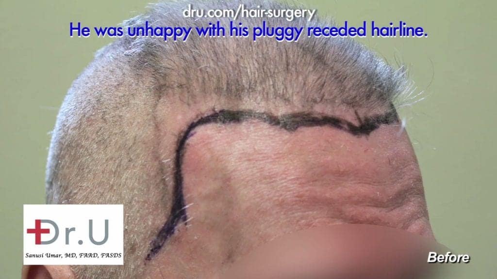 Scalp Reduction and Progressive Hair Loss Before and After Repair: Before Dr.UGraft advanced FUE hair surgery this patient's hair had a pluggy, unnatural appearance. Scalp Reduction and Progressive Hair Loss Before and After Repair: Before Dr.UGraft advanced FUE hair surgery this patient's hair had a pluggy, unnatural appearance.