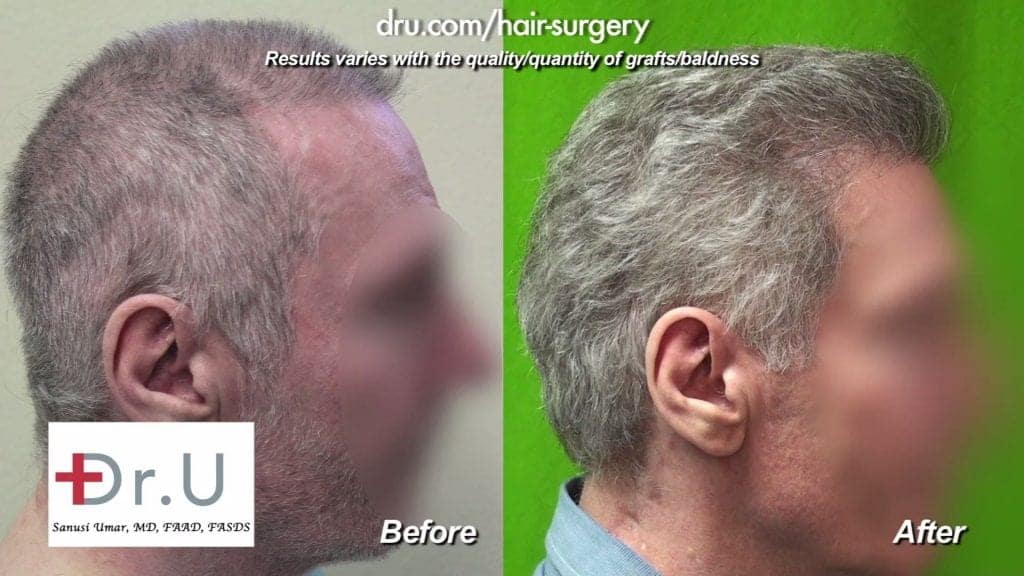 Scalp Reduction: Before and after repair. Scalp Reduction: Before and after repair.