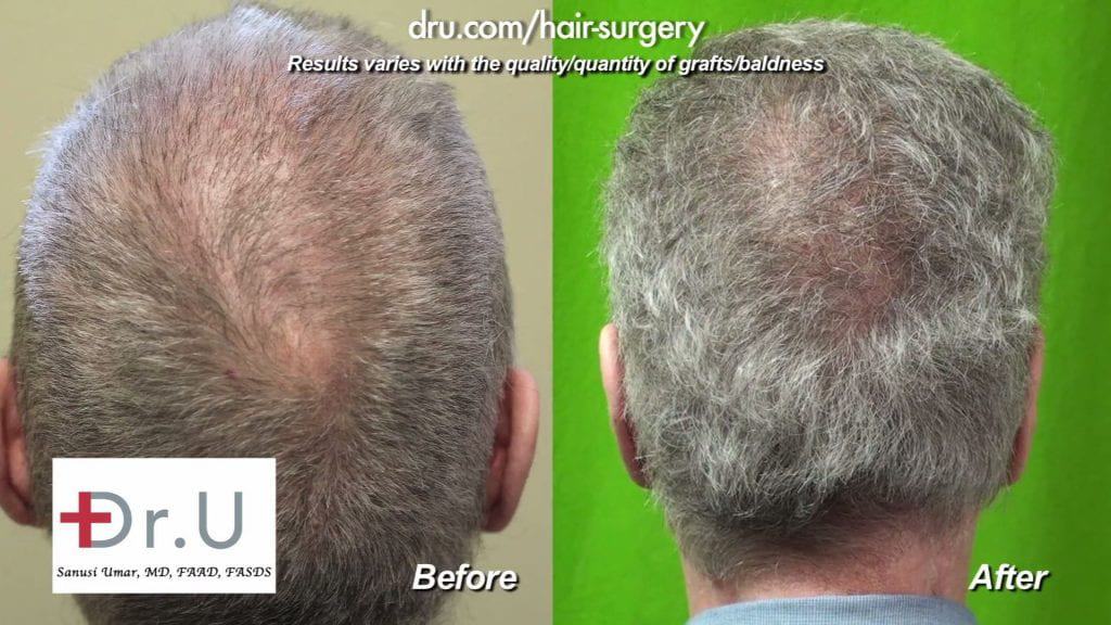 Crown view: Scalp Reduction and Progressive Hair Loss Repair Before and After Crown view: Scalp Reduction and Progressive Hair Loss Repair Before and After