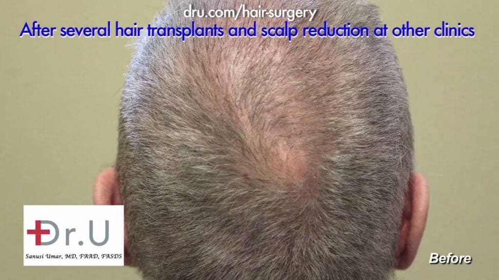 Scalp Reduction and Progressive Hair Loss Before and After Repair: Crown View Scalp Reduction and Progressive Hair Loss Before and After Repair: Crown View