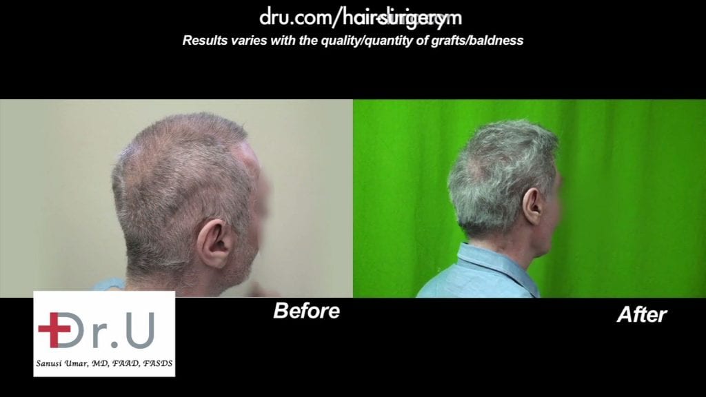 Scalp reduction: before and after repair Scalp reduction: before and after repair
