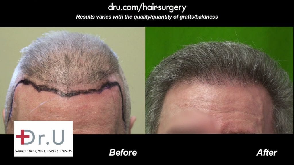 Before and After the Advanced FUE Hair Repair Surgery Before and After the Advanced FUE Hair Repair Surgery