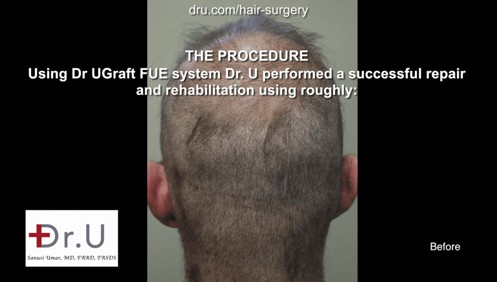 Before Dr.UGraft body hair transplant repair, the patient had a strip scar, depleted donor from strip surgery and multiple FUE and still very bald Before Dr.UGraft body hair transplant repair, the patient had a strip scar, depleted donor from strip surgery and multiple FUE and still very bald