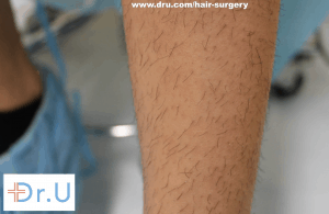 leg hair used for eyelash transplant