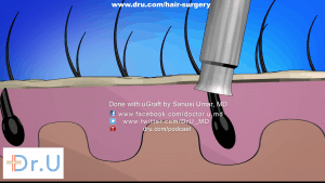 Dr. UGraft™