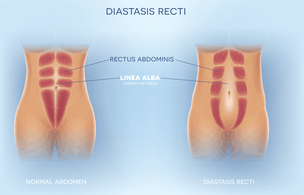 Emsculpt treatment resulted in a non surgical reduction of abdominal separation called diastasis recti Emsculpt treatment resulted in a non surgical reduction of abdominal separation called diastasis recti