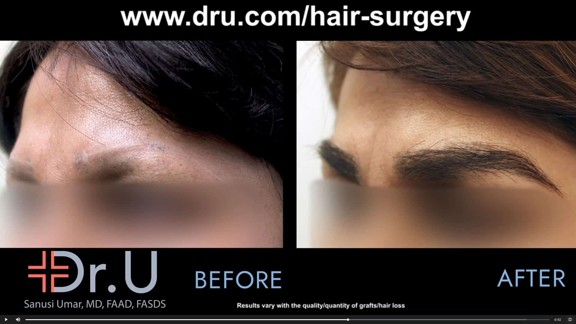 After a pubic hair to eyebrow transplant, this Los Angeles patient was able to restore a natural looking eyebrow that no longer looked scared or had eyebrow discoloration.* After a pubic hair to eyebrow transplant, this Los Angeles patient was able to restore a natural looking eyebrow that no longer looked scared or had eyebrow discoloration.*