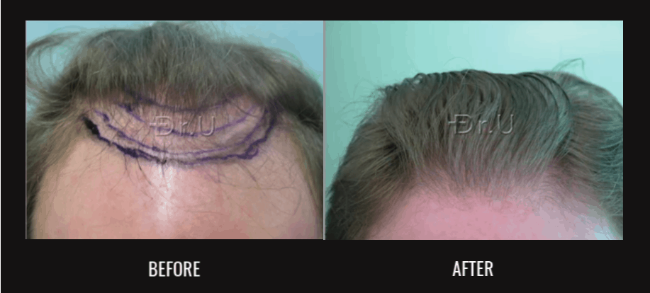 To meet patient's goal for retaining his Norwood 3 but yet fuller hair loss level, Dr U did a subtle hair restoration for a mature hair transplant coverage To meet patient's goal for retaining his Norwood 3 but yet fuller hair loss level, Dr U did a subtle hair restoration for a mature hair transplant coverage
