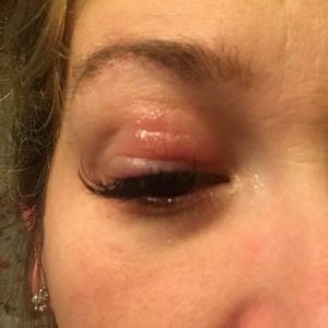 contact dermatitis