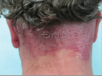 Hair Transplant Nape Donor Area, Following Graft Extraction Phase