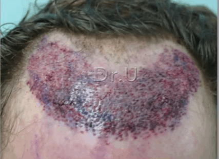 Hair Transplant Recipient Area Following Nape Hair Insertions